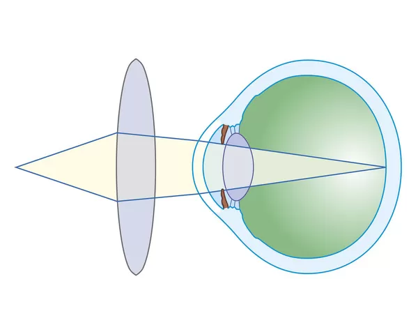 Cross section biomedical illustration of lens to correct