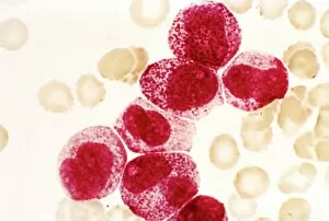 Histological Collection: Acute promyelocytic leukaemia, micrograph