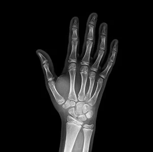 Broken Collection: Broken wrist bone, X-ray C017 / 7187