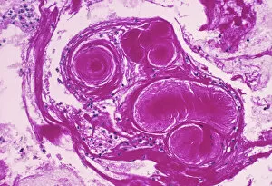 Light Micrograph Collection: Cystic fibrosis