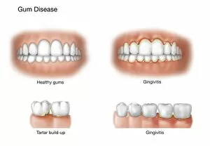 Swollen Collection: Comparison of healthy gums versus gingivitis